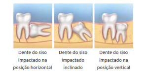 AngularImpaction